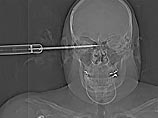 Сержант армии США в Ираке оправился после ранения в мозг 10-сантиметровым лезвием ножа