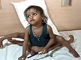 В индийском Бангалоре началась уникальная операция: врачи спасают девочку, родившуюся с четырьмя руками и ногами