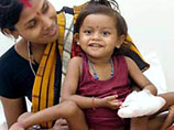 В Индии успешно прошла операция двухлетней девочки, которая родилась с четырьмя руками и четырьмя ногами. По отзывам врачей, у девочки есть все шансы начать жить нормальной жизнью