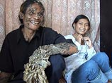 Индонезийский рыбак, опасавшийся, что корнеобразные наросты, выросшие на его теле, в конце концов убьют его, теперь надеется на исцеление благодаря американскому врачу и витамину А