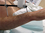 В Германии хирургами удалось пересадить пациенту две донорские руки