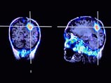 Французские нейрохирурги научились убивать раковые клетки с помощью лазера Французские нейрохирурги научились убивать раковые клетки с помощью лазера