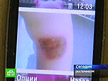 В Екатеринбурге медсестра нанесла ожоги 13 пациентам, применяя вместо антисептика средство для дезинфекции помещений