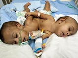 В Индонезии хирурги готовятся провести операцию по разделению сиамских близнецов, родившихся неделю назад. Предполагается, что это произойдет через несколько месяцев, как только малыши окрепнут