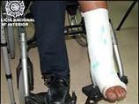 В Испании задержан наркокурьер со сломанной ногой, загипсованной кокаином