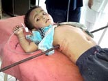 Индийский мальчик, которого насквозь пронзил стальной прут, остался жив