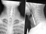 Рентгеновский снимок показал, что ножницы полностью дошли до пищевода
