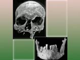 Разрушение костей около носа может быть признаком проказы, считает один из авторов исследования антрополог Гвен Роббинс из Аппалачского государственного университета