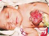 Индийские врачи в четверг утром были готовы к проведению срочной операции ребенку, родившемуся с сердцем, расположенным снаружи