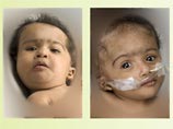В Австралии хирурги разделяют сиамских близнецов, сросшихся головами