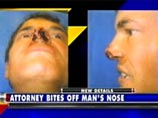 Опытный американский юрист откусил мужчине ноздрю в споре за место в туалете