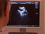 Второй в истории беременный мужчина ждет в феврале первенца и "безмятежно счастлив"
