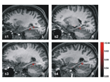 Ученые научились читать воспоминания, наблюдая за человеческим мозгом