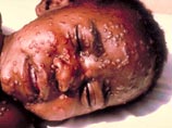 В Уганде возродилась оспа, которая с 1979 года считалась уничтоженной, опасается ВОЗ