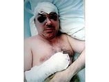 В больнице Кутузов провел около двух недель было установленно, что у пострадавшего в нескольких местах был пробит череп, сломаны руки и начало слабеть зрение