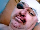 В больнице Кутузов провел около двух недель. В больнице установили, что у пострадавшего в нескольких местах был пробит череп, сломаны руки и начало слабеть зрение