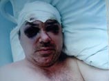 Георгий Кутузов скончался 22 мая от кровоизлияния в мозг. Причиной его гибели стали травмы головы и переломы, полученные 11 марта в ходе инцидента с конной милицией