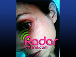 Издание RadarOnline.com  накануне обнародовало фото подбитого глаза Оксаны. Как утверждает Григорьева, она была избита Гибсоном во время их ссоры в начале января