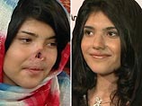 Афганской девушке, которую изуродовал муж-талиб, сделали новое лицо