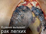 На пачках будут размещать фотографии сгнивших легких курильщиков На пачках будут размещать фотографии сгнивших легких курильщиков