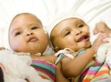 Британские хирурги разделили сиамских близнецов, сросшихся в области головы