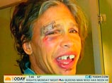 Американский телеканал NBC показал в передаче Today Show присланные лидером Aerosmith Стивеном Тайлером ужасные фотографии его лица после падения в душе - с разбитой бровью и выбитыми передними зубами