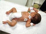 Младенец, родившийся из-за редкой аномалии с шестью ногами, был успешно прооперирован в Пакистане
