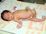 Фарук родился с редкой - одна на миллион - аномалией под названием полимелия, в ходе которой эмбрион в утробе развивается нормально, но представляет из себя сросшихся близнецов Фарук родился с редкой - одна на миллион - аномалией под названием полимелия, в ходе которой эмбрион в утробе развивается нормально, но представляет из себя сросшихся близнецов
