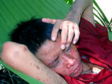 Власти Вьетнама намерены попросить международное сообщество о содействии в борьбе с таинственным кожным заболеванием, которое уже привело к гибели 19 человек