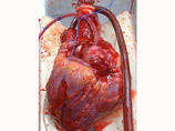 Специалисты больницы совместно с Институтом сердца Виктора Чанга разработали способ сохранения донорского сердца при помощи специального раствора и аппарата, который позволяет поддерживать сердце в нормальном состоянии ex vivo, то есть вне организма