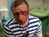 В Киевской области кавказцы дважды выстрелили в лицо депутату от партии Кличко