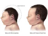 С вирусом Зика ученые связали врожденное уменьшение размеров мозга и черепа, что приводит к умственной отсталости у младенцев