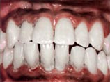 По мнению исследователя, во время длительного перелета с Земли на Марс вследствие невесомости человек может потерять значительные объемы костного вещества и зубной эмали, что приведет в конечном итоге к полной "беззубости"