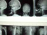 С помощью рентгена установлена определенная зависимость между объемом черепа и сужением канала носоглотки