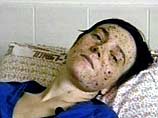 После ряда операций Татьяне Сапуновой удалось восстановить двигательные функции, провести косметические процедуры и вернуть зрение После ряда операций Татьяне Сапуновой удалось восстановить двигательные функции, провести косметические процедуры и вернуть зрение