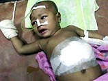 В Индии прооперировали беременного младенца