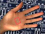 Электронный чип будет вживлен в руку девочке в поликлинике при местном наркозе