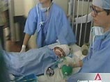 Сингапурские врачи готовы разделить 27-летних сиамских близнецов