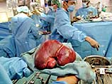 Итальянские врачи провели необычную операцию. Они извлекли печень из тела онкологического больного, вылечили ее и затем имплантировали тому же человеку