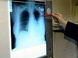 Диагноз "атипичная пневмония" 25-летнему жителю Благовещенска пока официально не подтвержден
