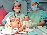 В Аргентине родились уникальные сиамские близнецы
