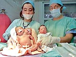 В Аргентине умерли сиамские близнецы, у которых было одно туловище и 2 головы В Аргентине умерли сиамские близнецы, у которых было одно туловище и 2 головы