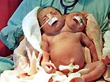 В Аргентине умерли сиамские близнецы, у которых было одно туловище и 2 головы