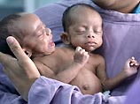 У новорожденных мальчиков две ноги, четыре руки, две головы, раздельные желудки, сердца и легкие. Родители оставили их в Индийском институте медицинских наук