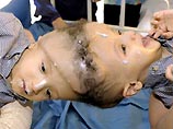 В США врачи предпримут попытку разделить сиамских близнецов, сросшихся черепами