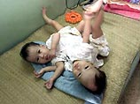 В столице Вьетнама Ханое в четверг успешно прошла операция по разделению сиамских близнецов