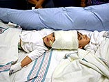 Первая из серии операций по разделению сросшихся головами полуторогодовалых сиамских близнецов из Филиппин проведена в понедельник в Нью-Йорке