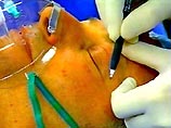 Ученые готовы осуществить трансплантацию лицевых тканей от мертвого человека живому