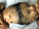 Состояние сиамских близнецов, родившихся в Египте со сросшимися макушками, нормализовалось