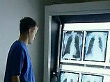 Американские ученые создали вакцину, тормозящую развитие рака легких Американские ученые создали вакцину, тормозящую развитие рака легких